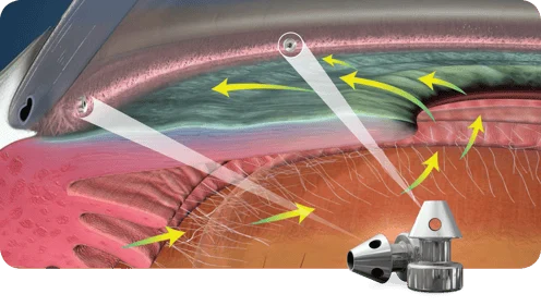 Tratamento do glaucoma